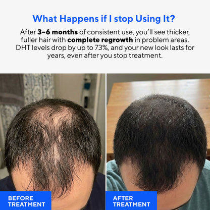 Glow Peptide Infusion – Microneedling Hair Growth Therapy with GHK-Cu & Multi-Peptide Complex