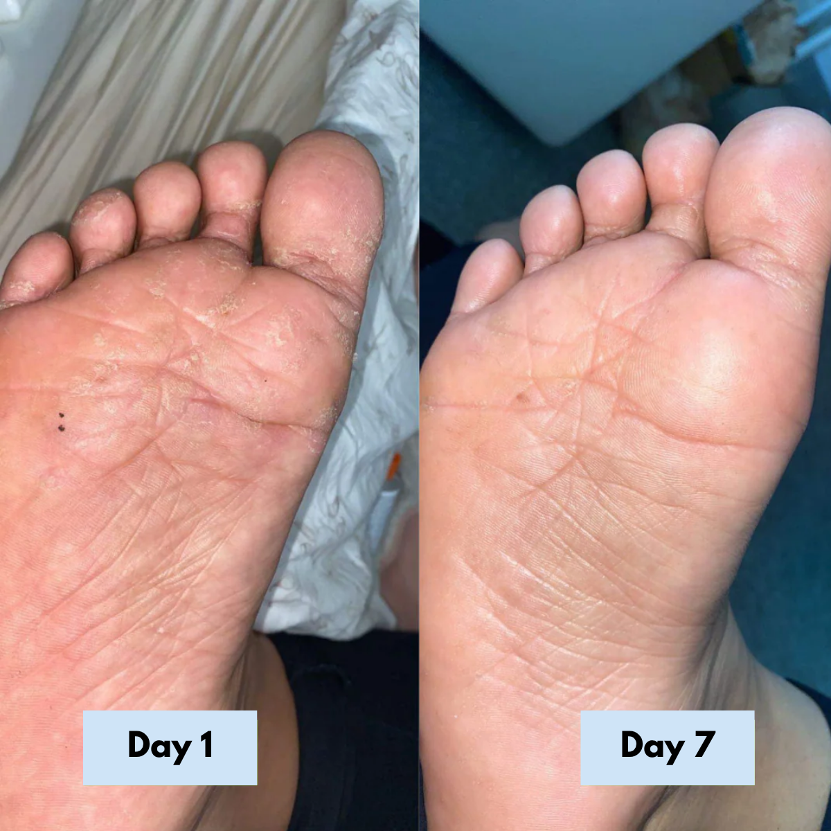 Antifungal Relief Soap Bar