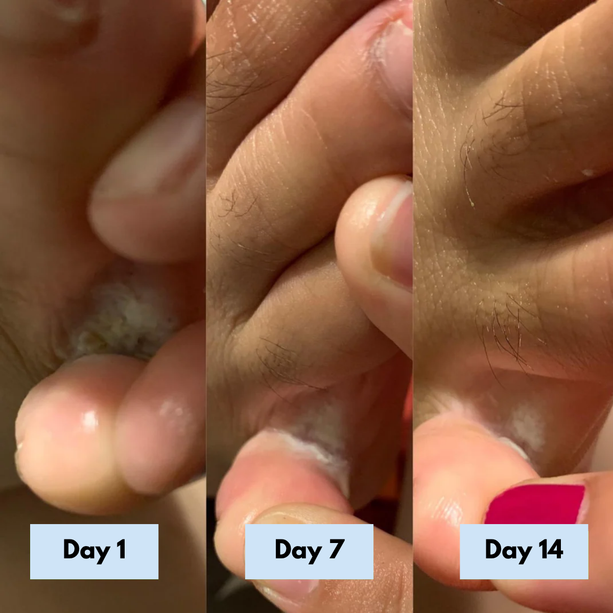 Antifungal Relief Soap Bar