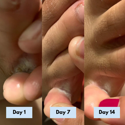 Antifungal Relief Soap Bar